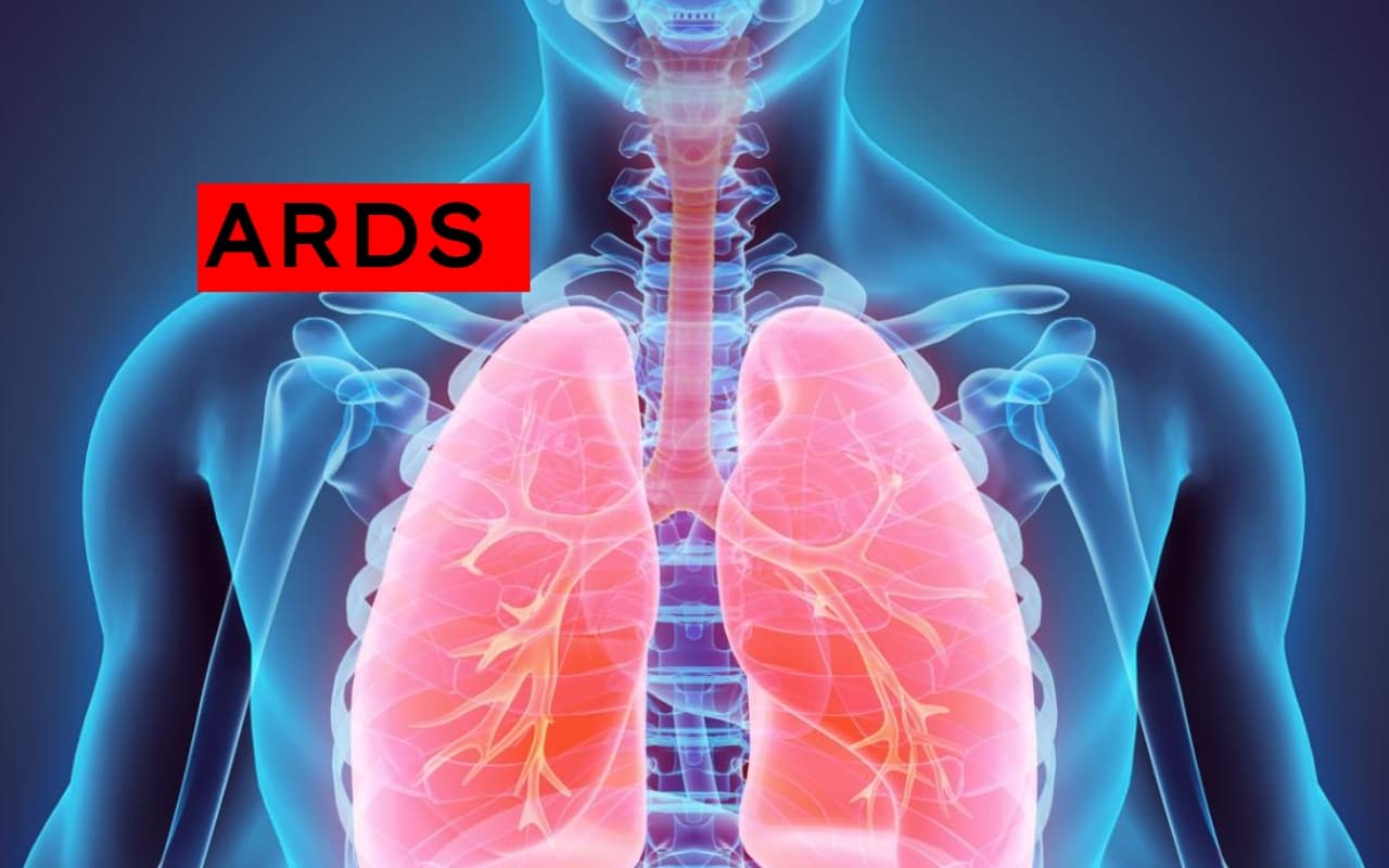 ARDS की वजह से तो नहीं हो रही सांस लेने में परेशानी? जानें इस गंभीर बीमारी के कारण, लक्षण, बचाव और इलाज