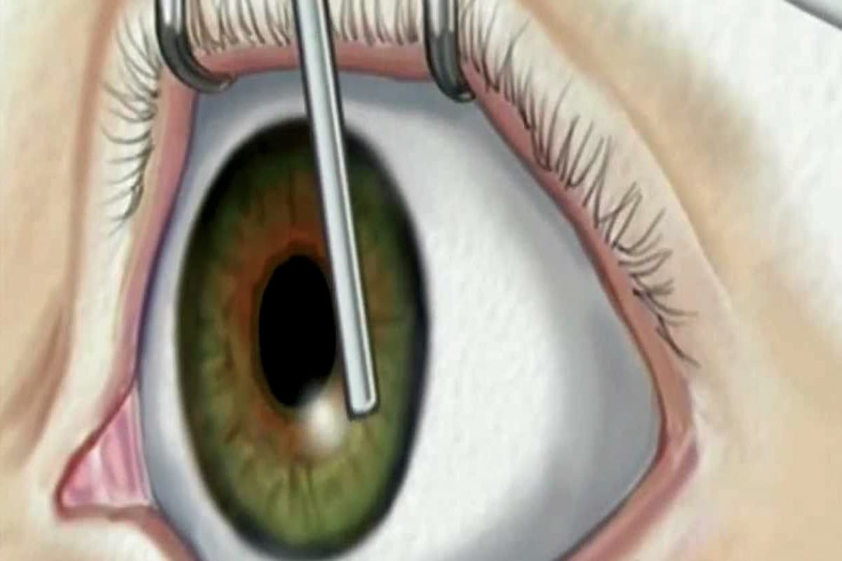 आयुष्मान योजना के तहत आंखों की सर्जरी में झारखंड का स्थान देश में दूसरा, फिर भी उपलब्धि शक के दायरे में