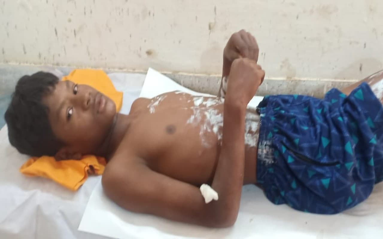 पश्चिमी सिंहभूम में नक्सलियों द्वारा लगाया गया IED ब्लास्ट में 1 युवक घायल, बेहतर इलाज के लिए चाईबासा रेफर