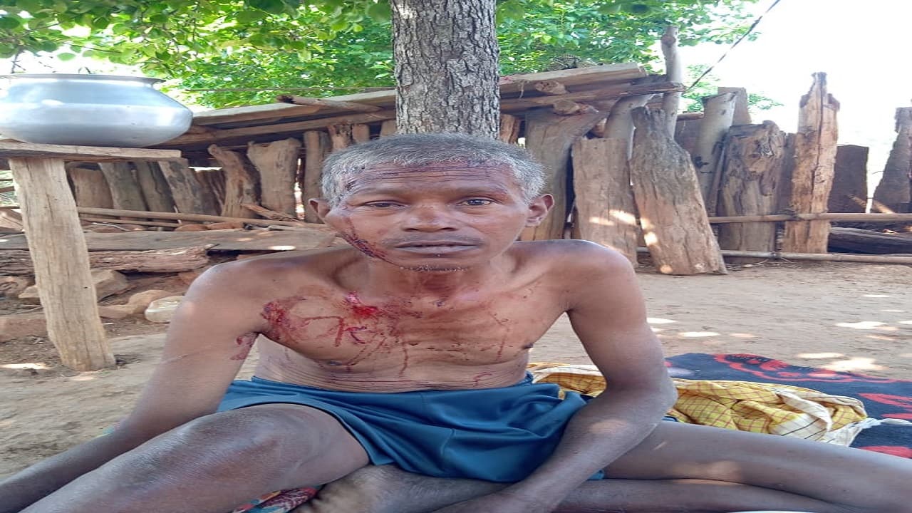 Jharkhand News: महुआ चुनने जंगल गये ग्रामीण पर भालू का हमला, चेहरा व छाती पर जख्म के निशान, चल रहा इलाज