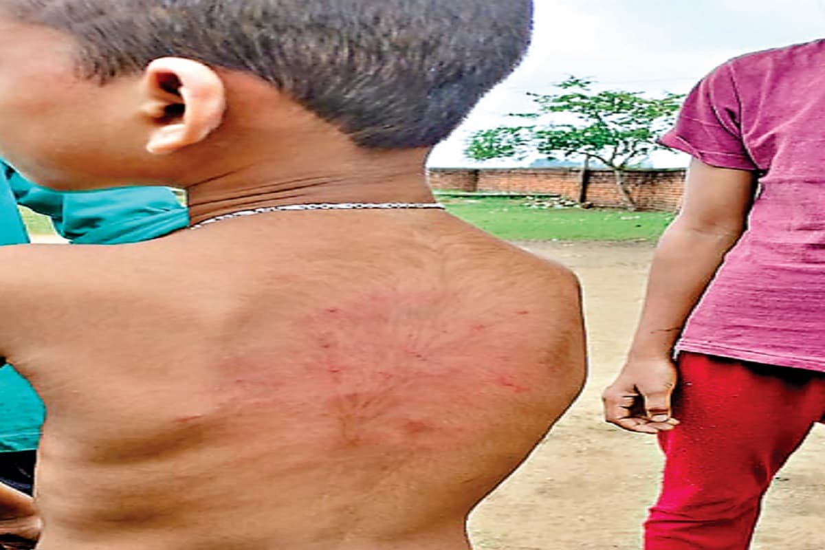 एक दिन अनुपस्थित रहने पर बच्चे की शिक्षक ने की बेरहमी से पिटाई, BEEO ने कहा होगी कार्रवाई