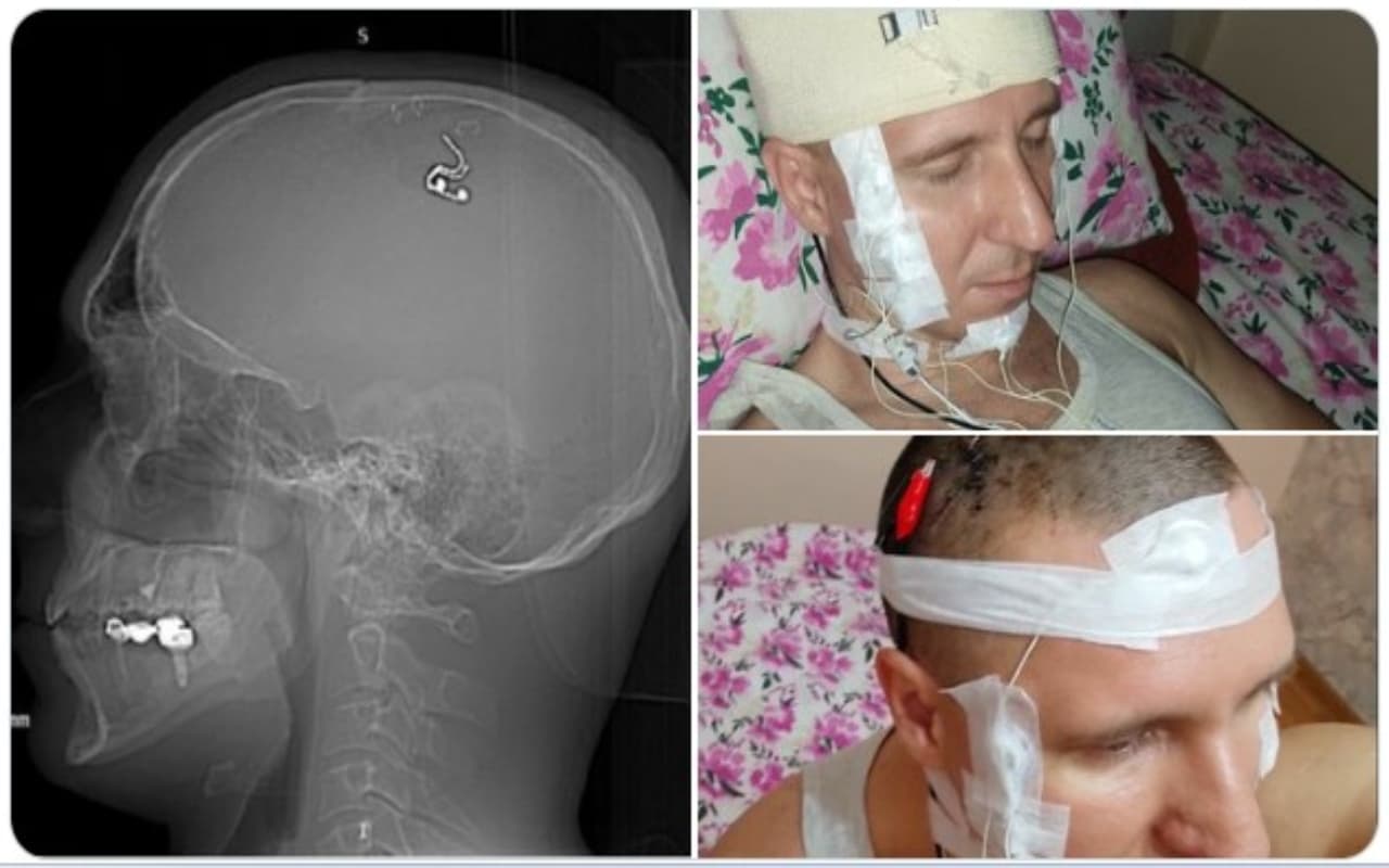 सपने को कंट्रोल करने के लिए आप ऐसा हरगिज न करें, जैसा इस रूसी शख्स ने किया; पढ़ें पूरी खबर