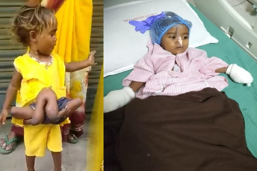 नवादा की 4 पैर और 4 हाथ वाली बच्ची को मिला नया जीवन, सोनू सूद ने कराया सफल ऑपरेशन