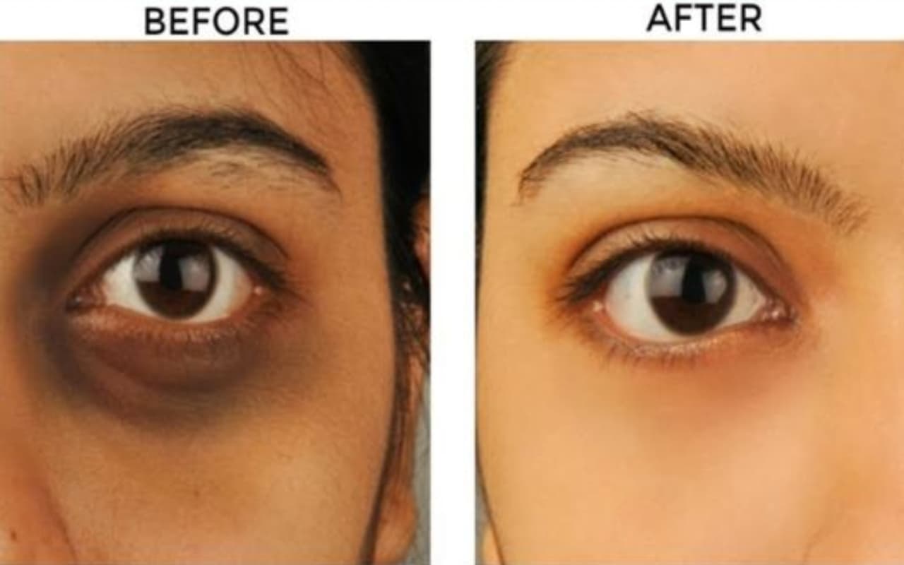 Dark Circles से छुटकारा पाने के लिए महंगी-महंगी क्रीम के जगह करें ये योगासन