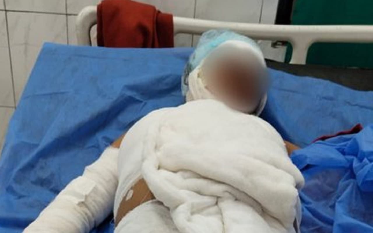 बिहार: मुजफ्फरपुर के सरैया में दोस्त ने पेट्रोल छिड़क कर युवक को जिंदा जलाया, 60 प्रतिशत झुलसा