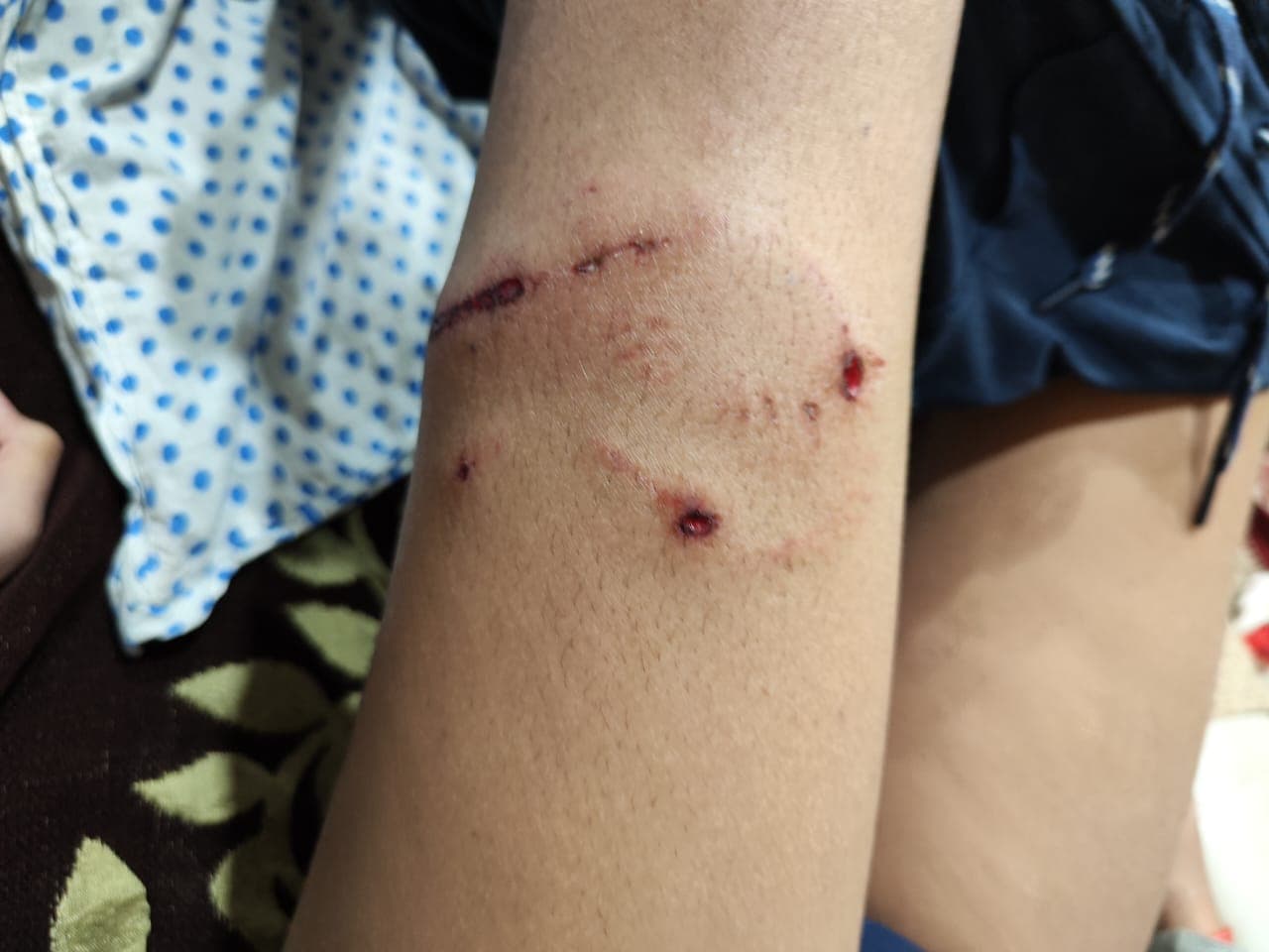 Lucknow: सृष्टि अपार्टमेंट में आवारा कुत्तों के झुंड का लड़के पर हमला, स्थानीय लोगों में आक्रोश, दी धमकी