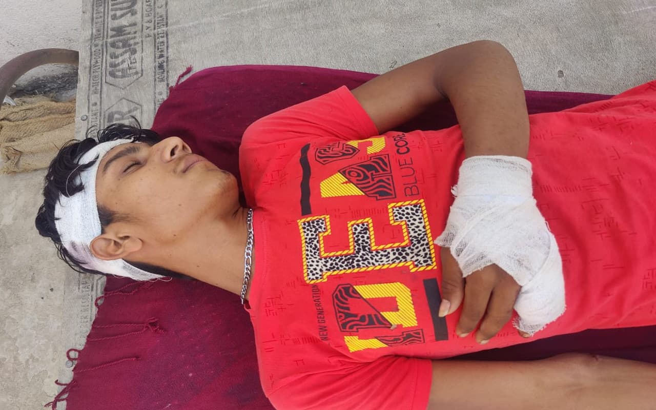 झारखंड : दुमका के सरैयाहाट में एसिड अटैक, एक ही परिवार के 4 लोग झुलसे, मारपीट भी की गयी