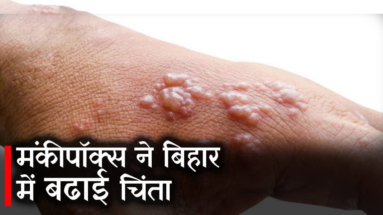 Monkey Pox ने बिहार में बढ़ाई लोगों की चिंता, स्वास्थ्य विभाग हुआ अलर्ट