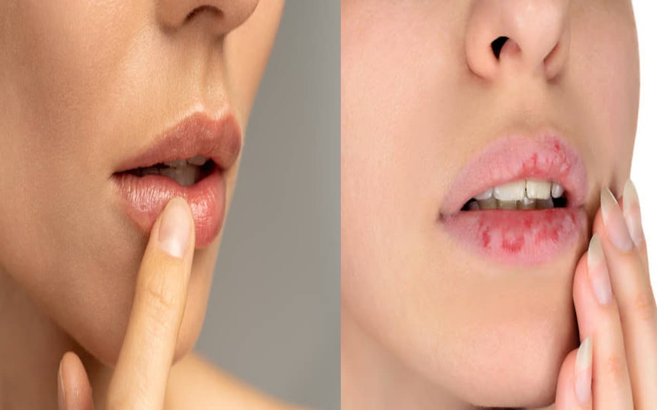 Dry Lips in Summer: गर्मियों में फटे होठों से छुटकारा पाने के टिप्स