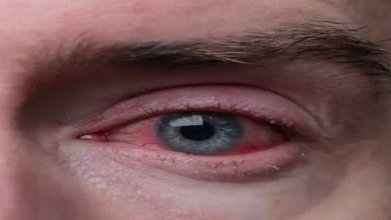 क्या आई फ्लू के मरीज की आंखों को देखने से भी फैलता है संक्रमण? जानिए वो सब जानकारी जिससे आप भी होंगे अंजान...