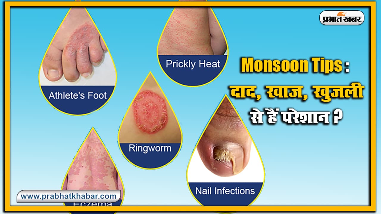 Monsoon Tips : दाद, खाज खुजली से लेकर मानसून में होने वाली इन फंगल इंफेक्शन को ऐसे करें दूर