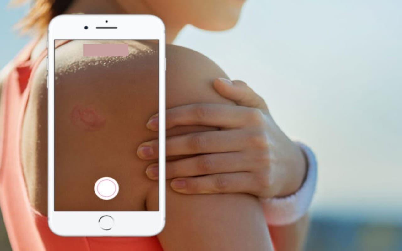 Google Lens से पता लगेगी त्वचा से जुड़ी बीमारी, ये रहा तरीका