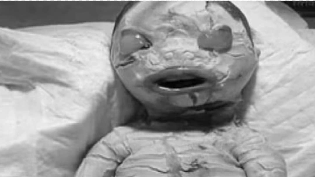 बरेली के सीएचसी में जन्मा 'हार्लेक्विन बेबी', 30 लाख बच्चों में से एक में होती है समस्या, जानें बीमारी की वजह