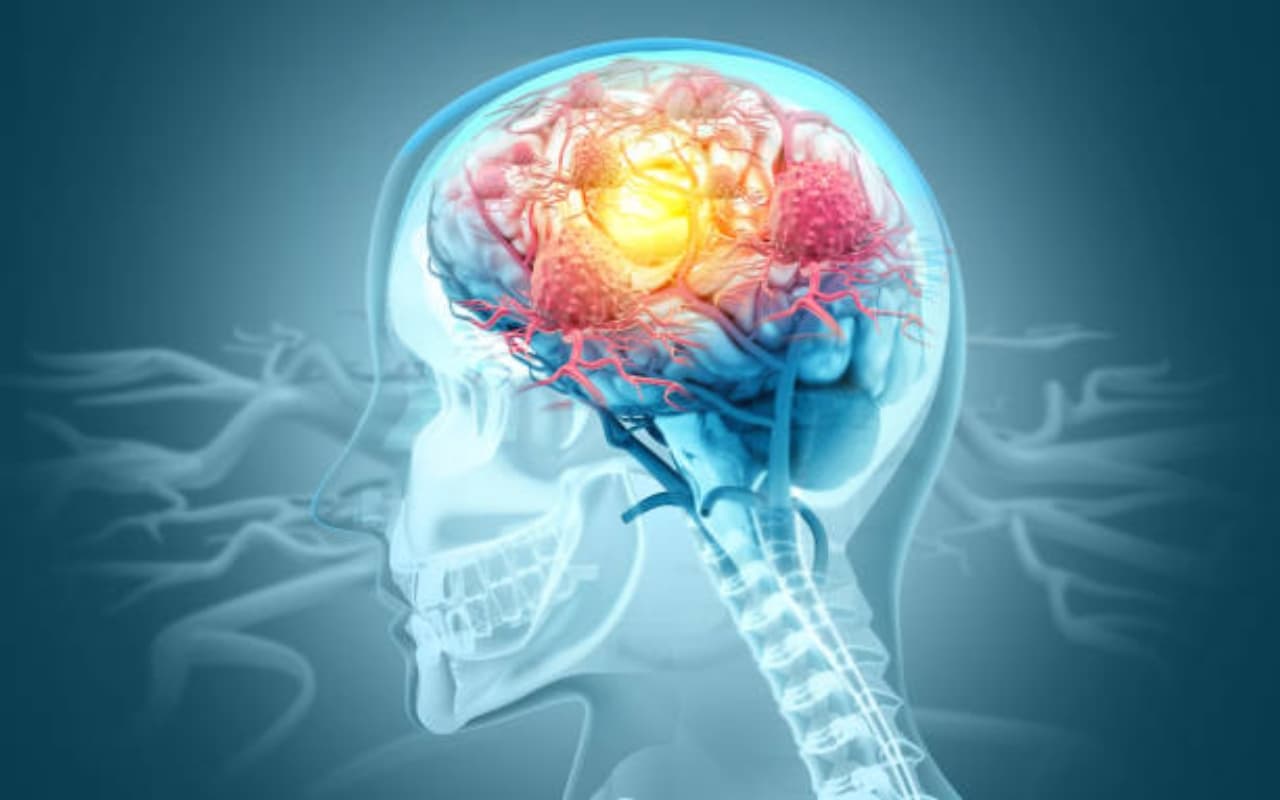 Research Alzheimer’s Treatment : स्टेम सेल उपचार ने अल्जाइमर के लक्षणों को घटाने की जगाई उम्मीद