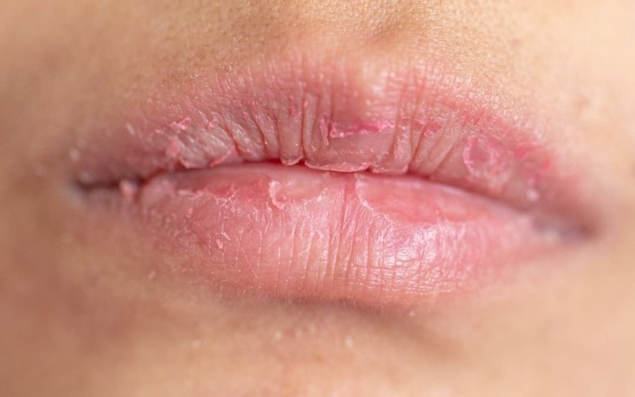 Beauty Tips: सर्दी शुरू होते ही फटने लगे हैं होंठ, तो आजमाएं ये घरेलू नुस्खे, तुरंत दिखेगा असर