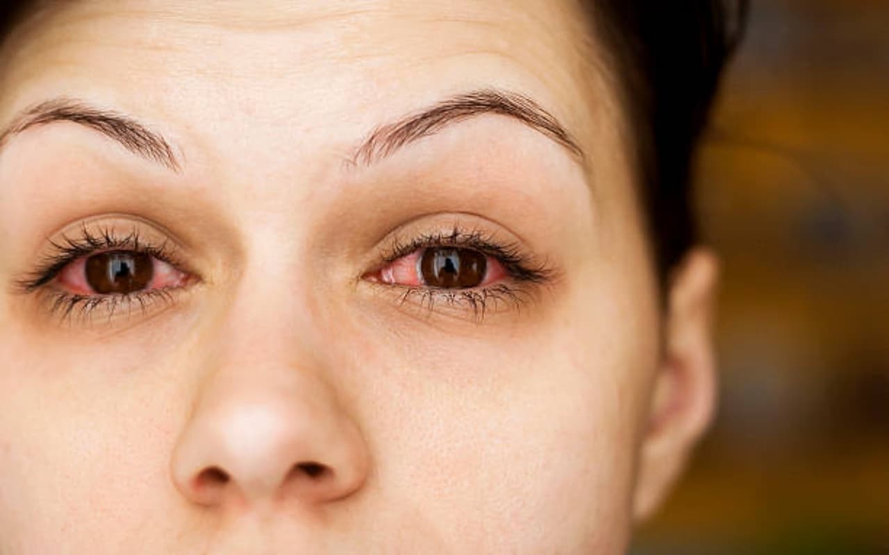 Conjunctivitis: क्या है आंख आना ? मानसून में हर गली में दिख रहे कंजंक्टिवाइटिस के मरीज, जानिए लक्षण और बचाव
