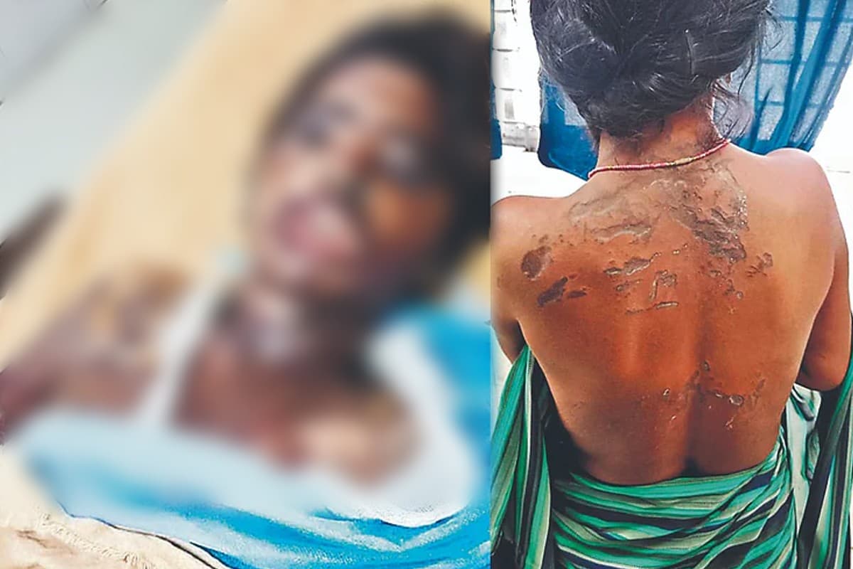 Jharkhand Acid Attack: झारखंड के चतरा में युवक ने मां के साथ सो रही युवती पर तेजाब फेंका