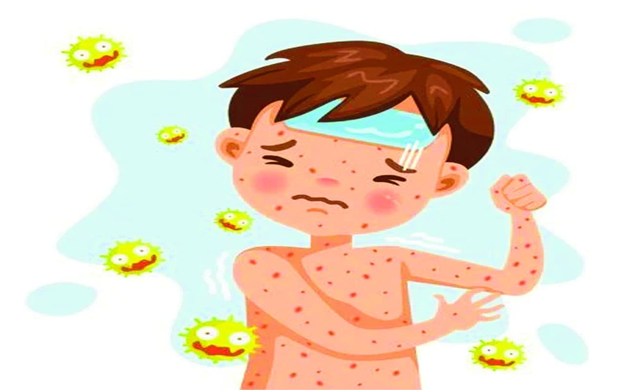 देशभर में खसरा से 14 बच्चों की मौत, 09 झारखंड के, आंकड़ों ने बढ़ायी चिंता