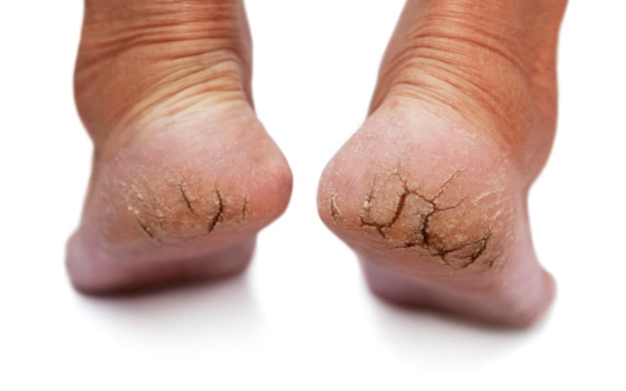 फटी एड़ियों से निजात पाने का रामबाण इलाज, पैर हो जाएंगे बेहद मुलायम