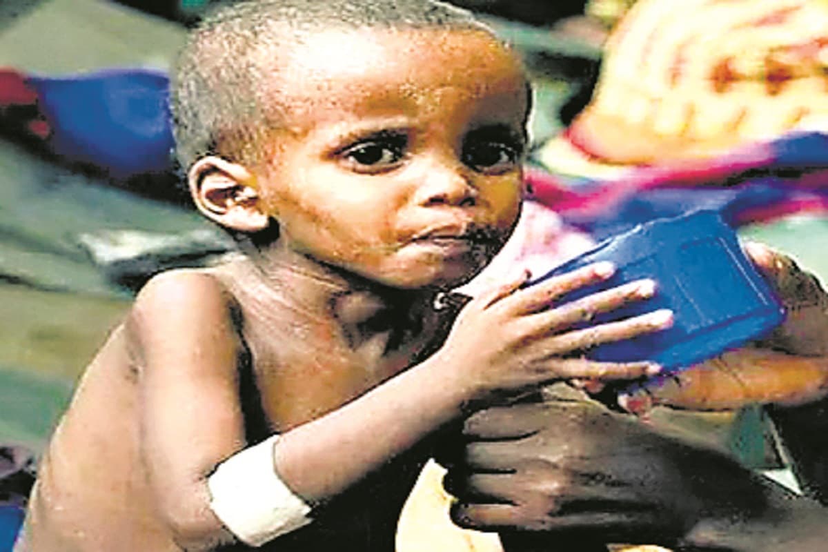 ओडिशा के 31 प्रतिशत बच्चे कुपोषित, विधानसभा में बच्चों में कुपोषण का मामला उठा