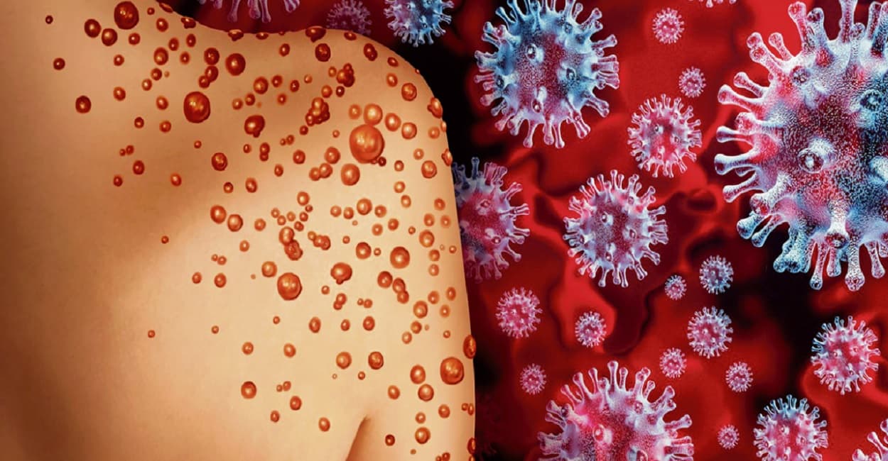 अलीगढ़ के युवक में मंकीपॉक्स के लक्षण दिखने पर प्रशासन के फूले हाथ पांव, रिपोर्ट में चिकन पॉक्स की पुष्टि