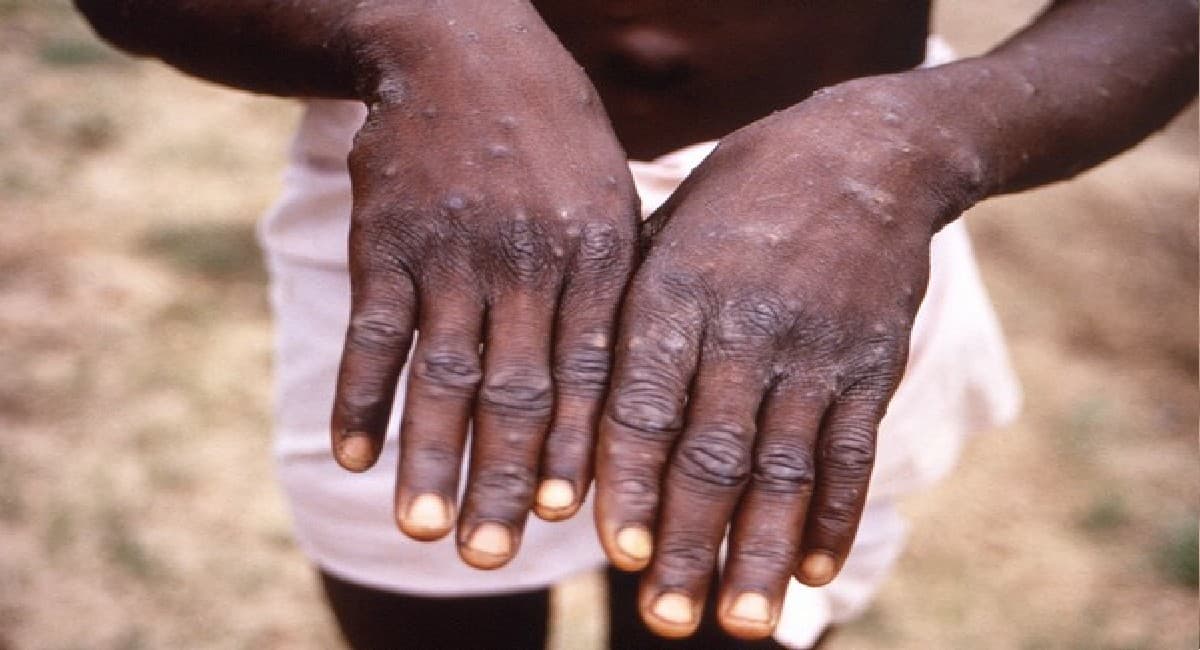 Monkey Pox पर राहत भरी खबर, आंध्र प्रदेश में मरीज की रिपोर्ट आयी निगेटिव, केरल सरकार ने किया ये इंतजाम