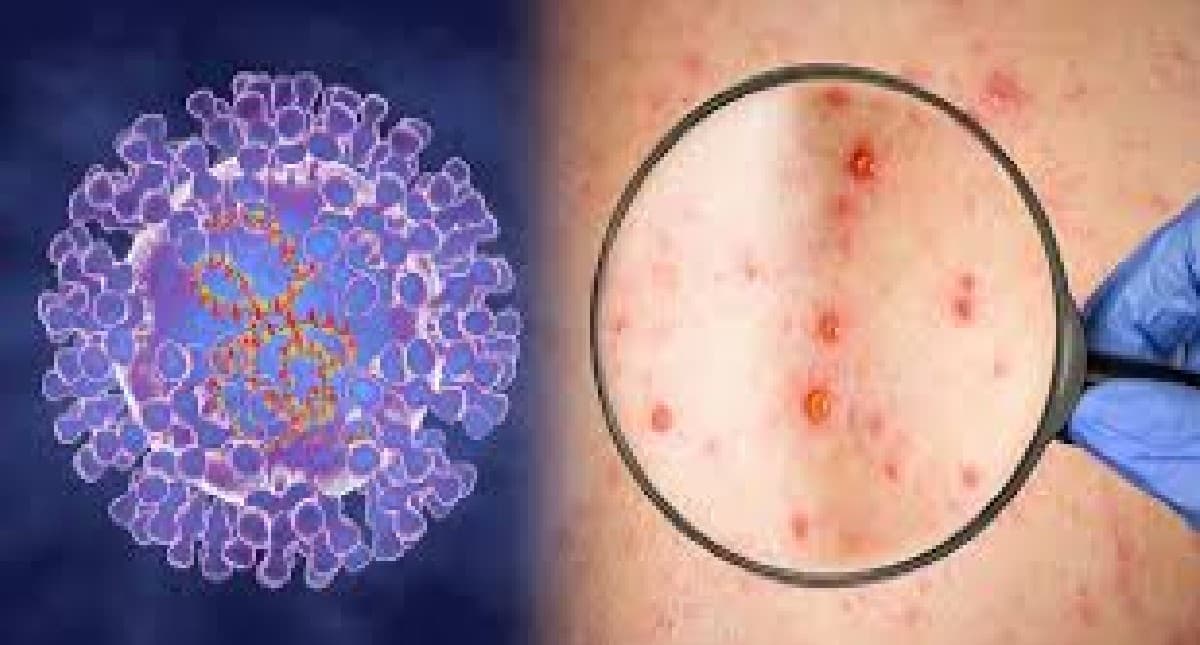 Mpox Case: दुनिया में पैर पसार रही नई महामारी, स्वीडन और पाकिस्तान में दर्ज किए गए मामले