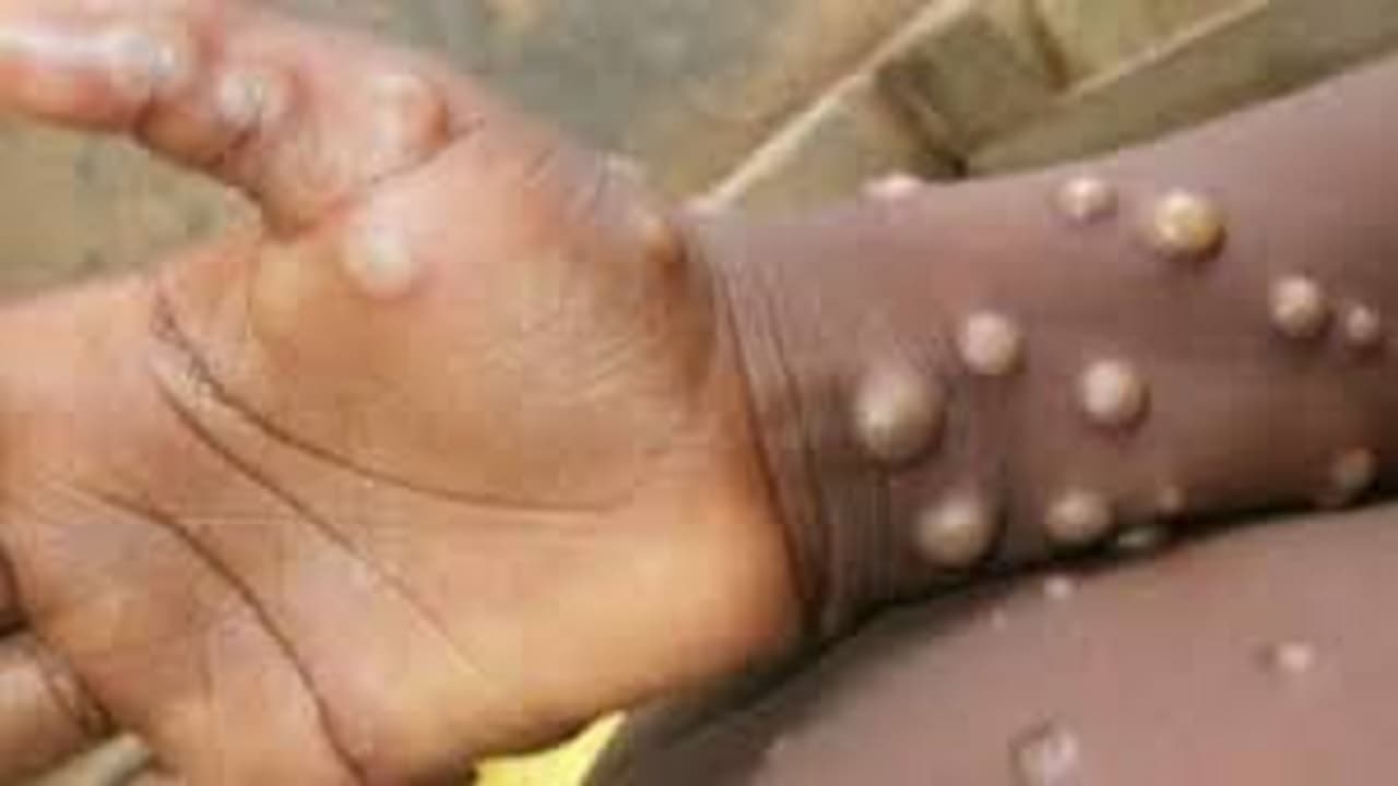 Monkeypox: दिल्ली में मंकीपॉक्स का एक और मरीज मिला, 35 साल के नाइजीरियाई युवक में हुई संक्रमण की पुष्टि