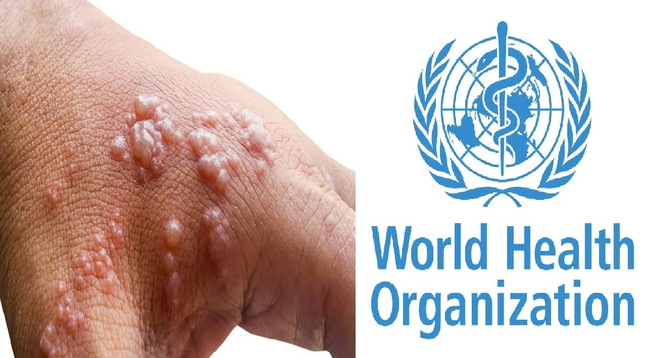 मंकीपॉक्स को लेकर बिहार के जिलों में अलर्ट, WHO के प्रतिनिधि आशा व एएनएम को देंगे ट्रेनिंग