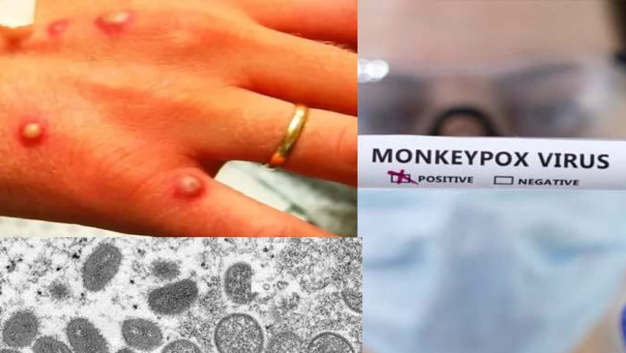 Monkeypox: स्वास्थ्य विभाग ने बताए मंकीपॉक्स से बचने के असरदार उपाय,लिस्ट में देखें क्या करें-क्या न करें