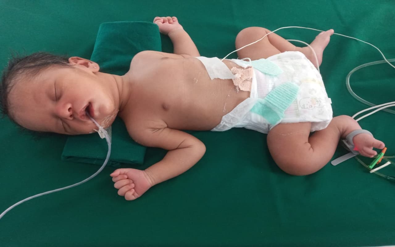 पटना में नवजात की दुर्लभ सर्जरी, पहली बार एक दिन के बच्चे के दिल में लगाया गया स्टेंट
