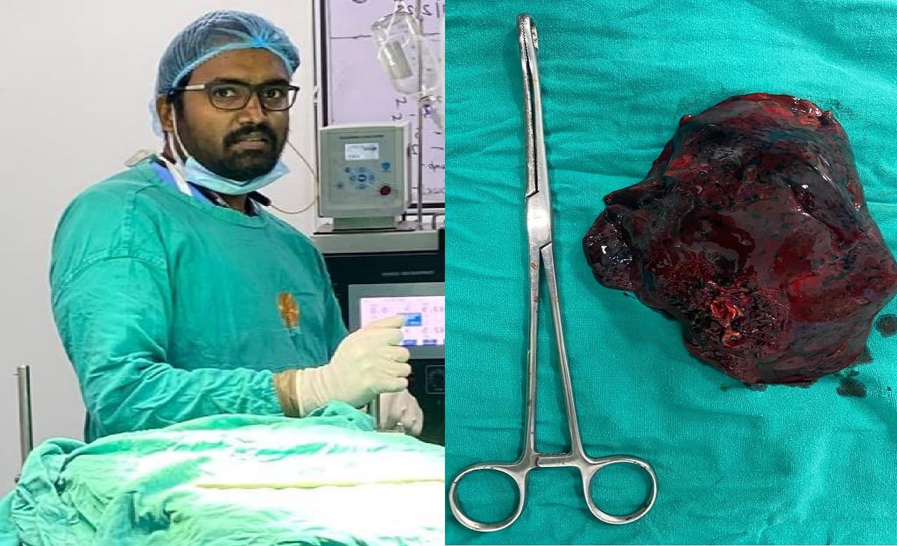 पटना के महावीर कैंसर संस्थान के डाक्टरों का कमाल, सफलतापूर्वक किया थर्ड स्टेज लंग कैंसर का जटिल ऑपरेशन