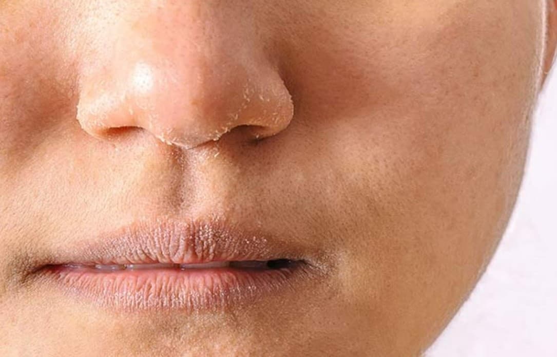 Home Remedies For Dry Skin: सर्दियों में चेहरा रहता है रूखा तो अपनाएं ये आसान घरेलू उपाय