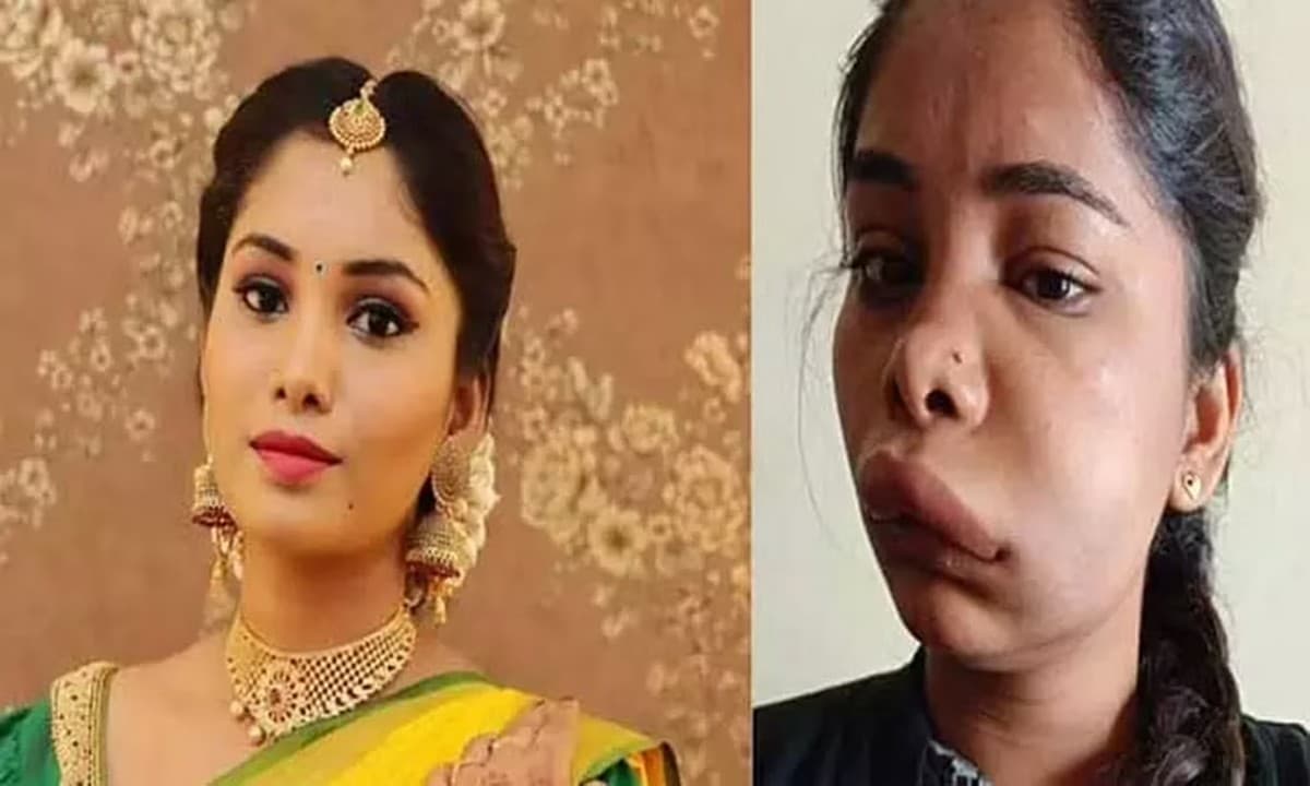 कन्नड़ एक्ट्रेस Swathi Sathish का सर्जरी के बाद ऐसा बिगड़ा चेहरा, एक्ट्रेस के हाथ से गए कई प्रोजेक्ट