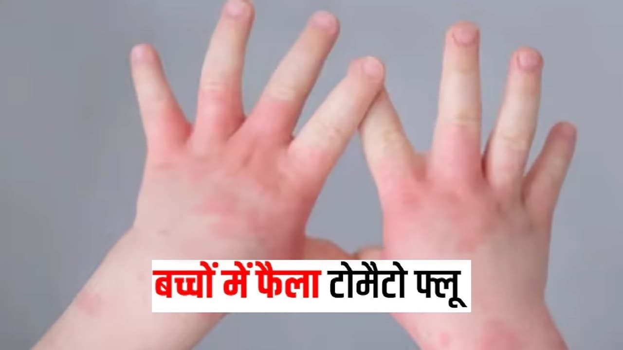 टोमेटो फ्लू पर अलर्ट, जाने आपके बच्चे के लिए है कितना घातक, स्वास्थ्य मंत्रालय ने जारी किया एडवाइजरी
