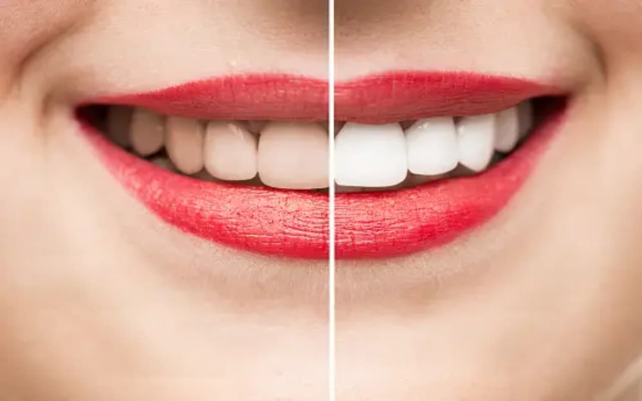 Teeth Whitening: दातों की सफेदी और मजबूती बढ़ाएगा ये फल, आज से ही खाना करें शुरू