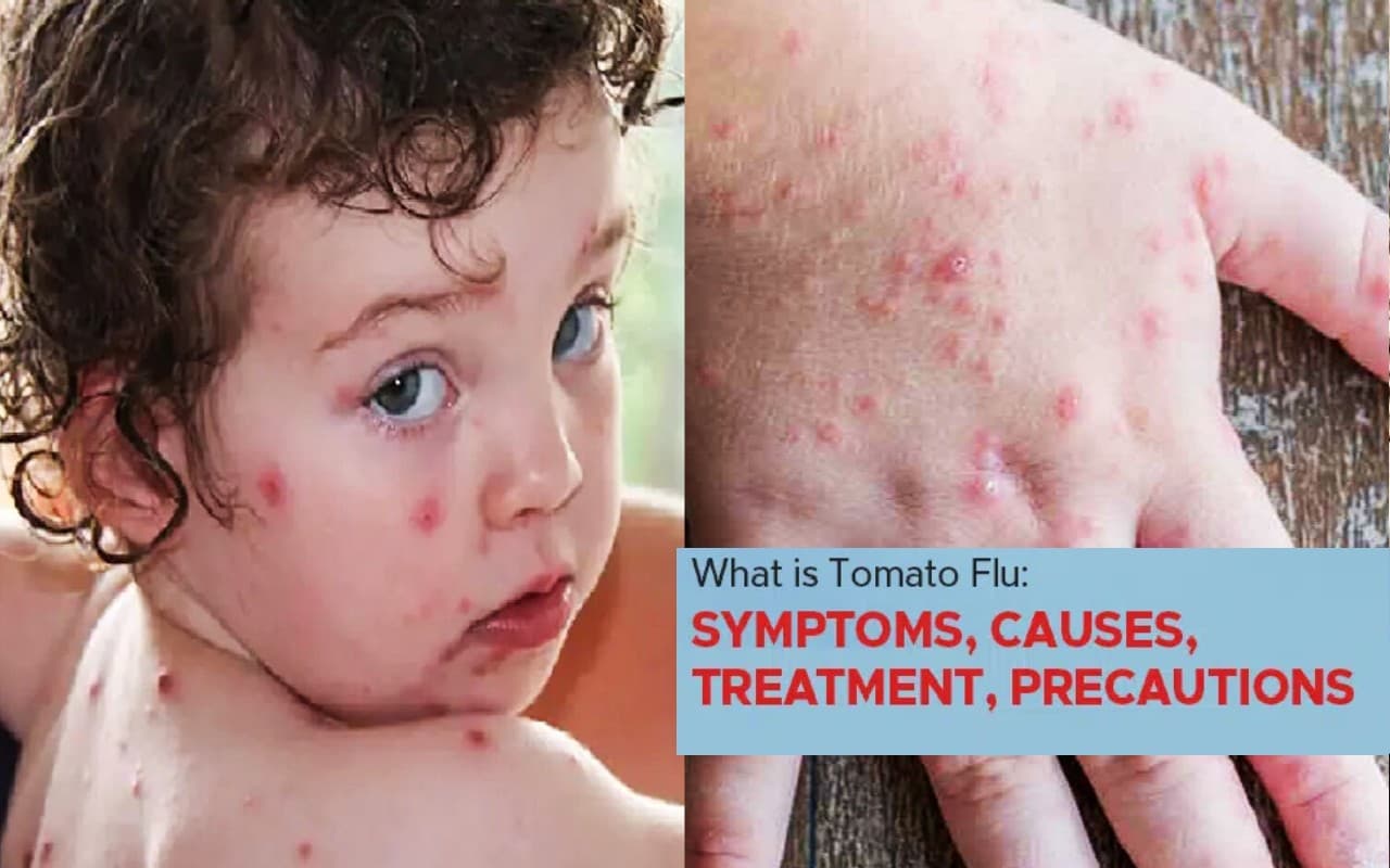 Tomato Flu: क्या है टोमैटो फ्लू, कितनी खतरनाक है ये बीमारी, जानें इसके लक्षण और बचने के उपाय