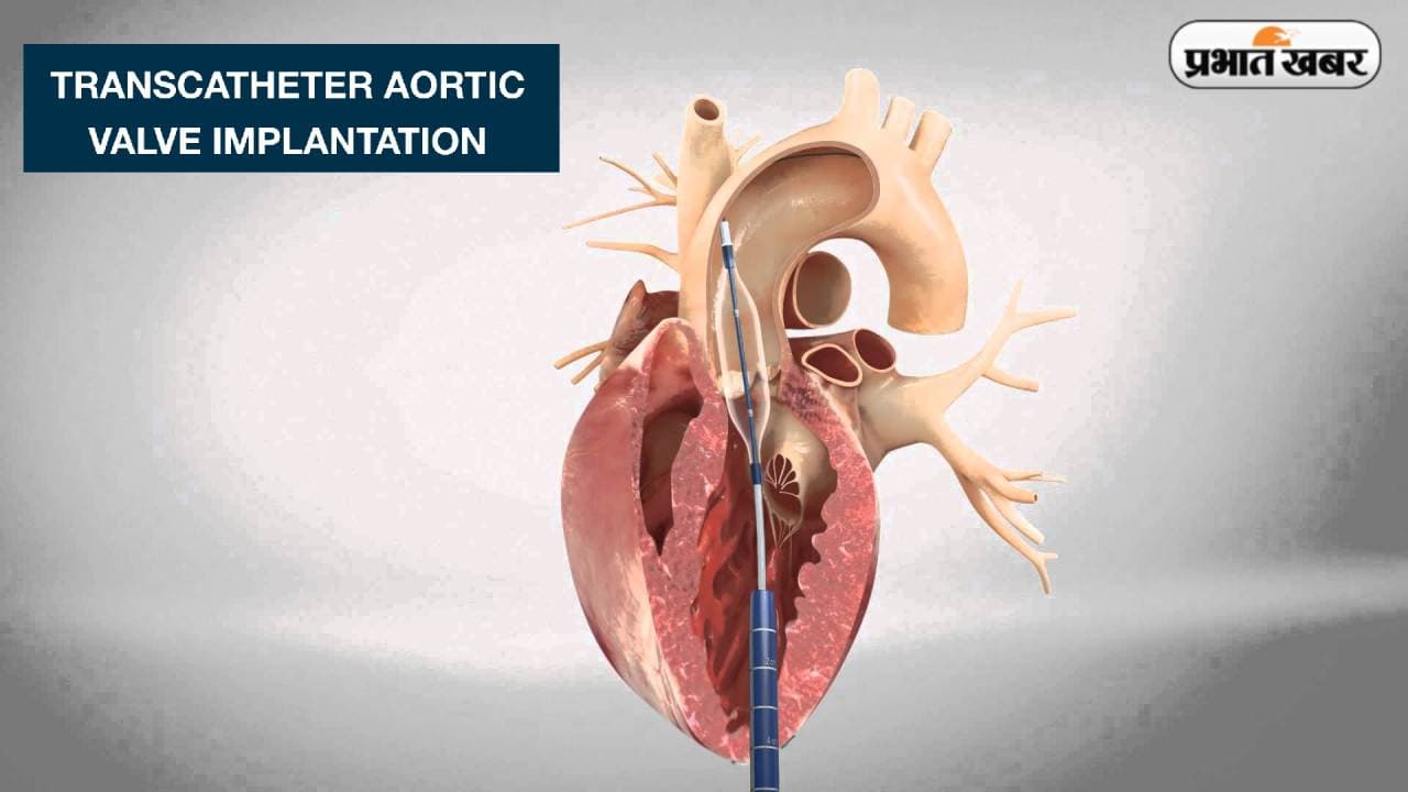 पाकिस्तान के व्यक्ति का जयपुर में हुआ टीएवीआई से इलाज, मिला जीवनदान, जानें क्या है ये प्रक्रिया