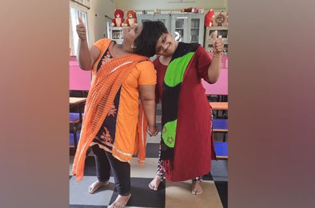 जज्बा: हैदराबाद में सिर से जुड़ी दो बहनों ने पास की इंटर की परीक्षा, जानिए पूरी कहानी