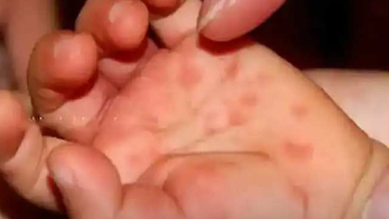 टौमैटो फीवर वायरस से 80 बच्चे संक्रमित, केरल और तमिलनाडु में रेड अलर्ट जारी