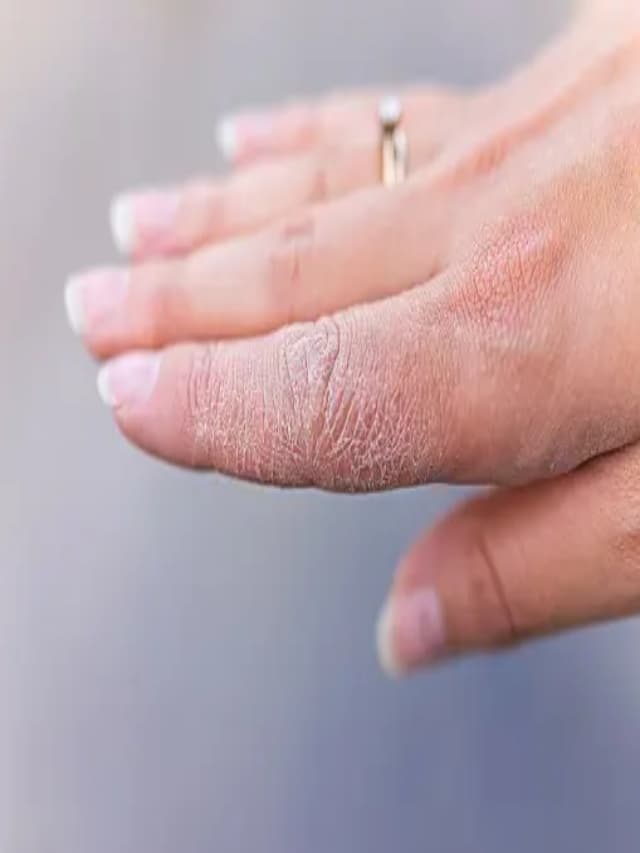 Winter Care : सर्दियों में फटी उंगलियां की करें खास देखभाल, फॉलो करें ये खास टिप्स