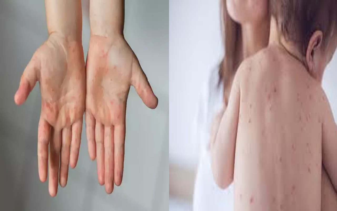 Measles Infection: खसरा संक्रमण के मामलों ने बढ़ाई चिंता, मुंबई में 11 नए मामले, अबतक 8 की मौत