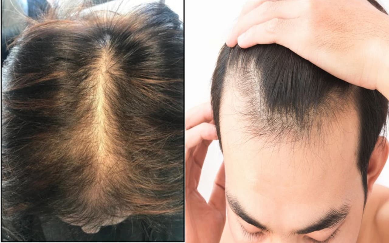 Hair Care Tips: 40 की उम्र के बाद महिला और पुरुषों के क्यों झड़ते हैं बाल, ऐसे करें देखभाल