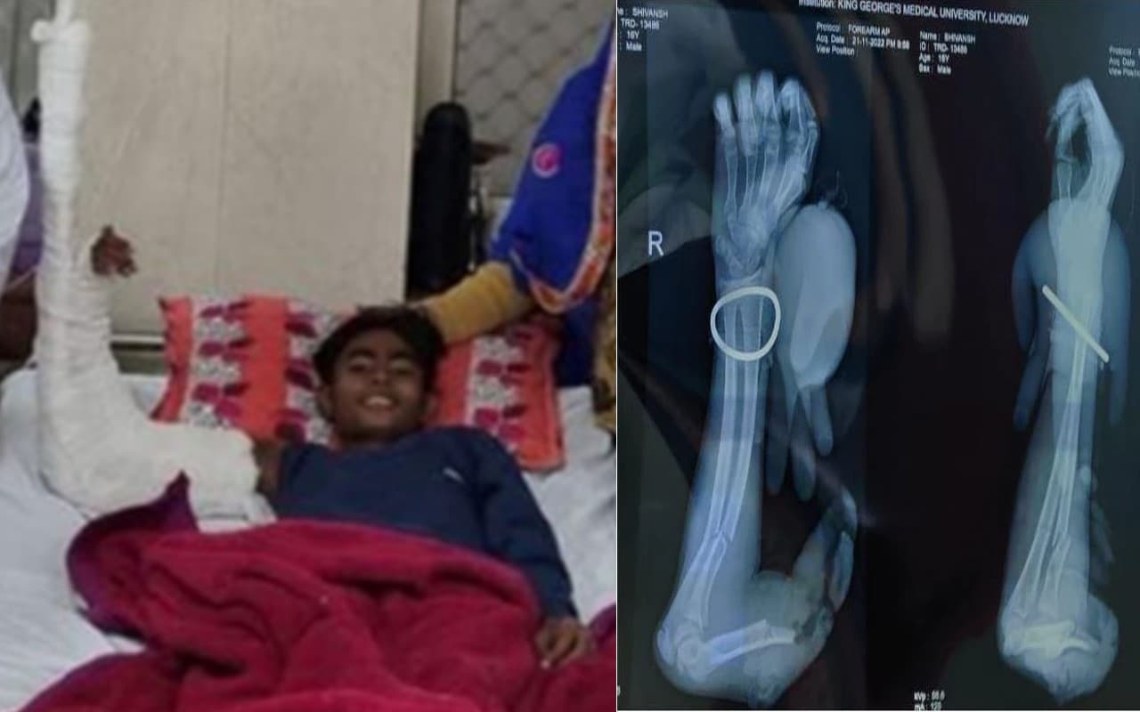 दो टुकड़े में कटे हाथ को लेकर अस्पताल पहुंची लड़की, डॉक्टर्स ने की सफल सर्जरी