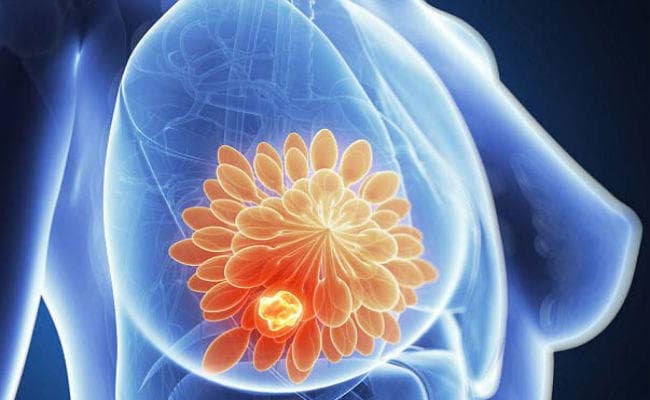 तीन हालिया शोधों से जगी उम्मीद: ब्रेस्ट कैंसर का अब आसान होगा इलाज