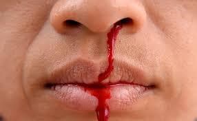 हावड़ा में भाजपा समर्थक की टूटी नाक