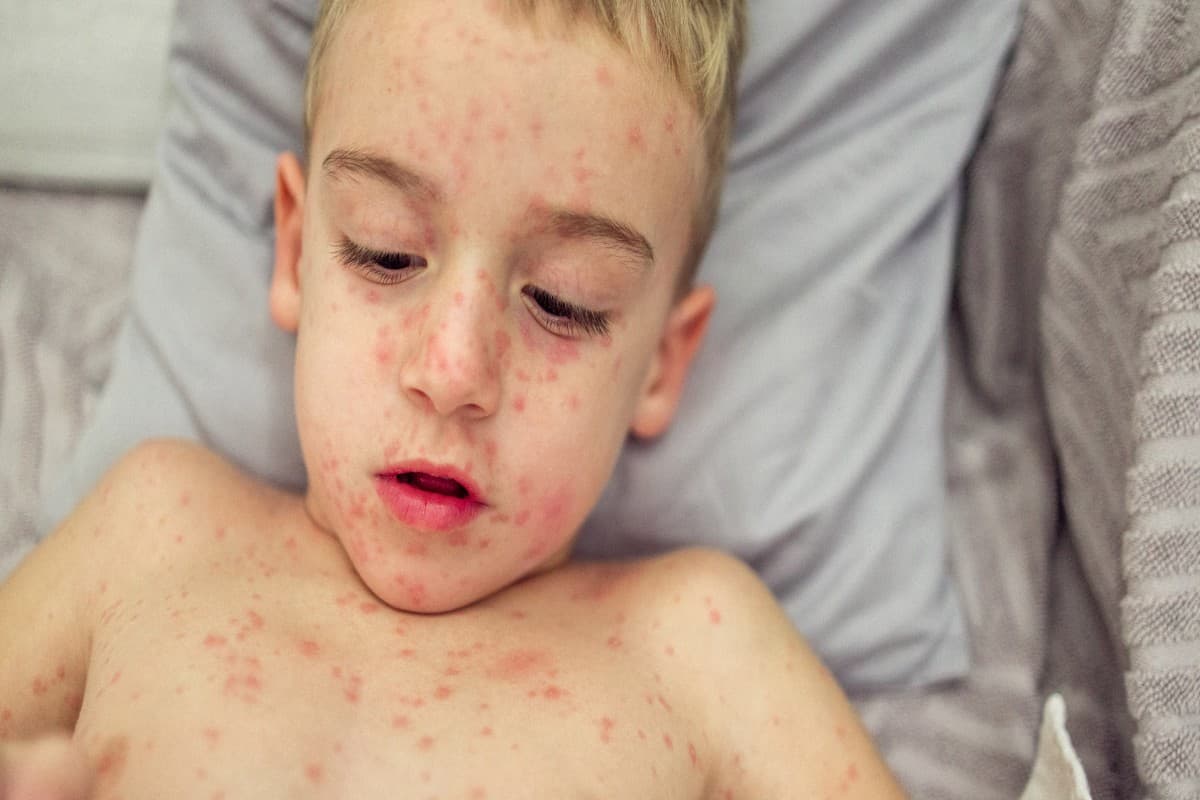 Measles Symptoms: बच्चों में तेजी से बढ़ रहा है 'खसरा' का खतरा, एक्सपर्ट से जानें कैसे करें बचाव