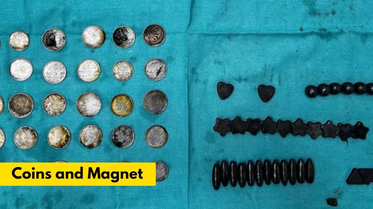 Viral: बंदे ने निगल डाले 39 सिक्के और 37 चुंबक, फिर जो हुआ...