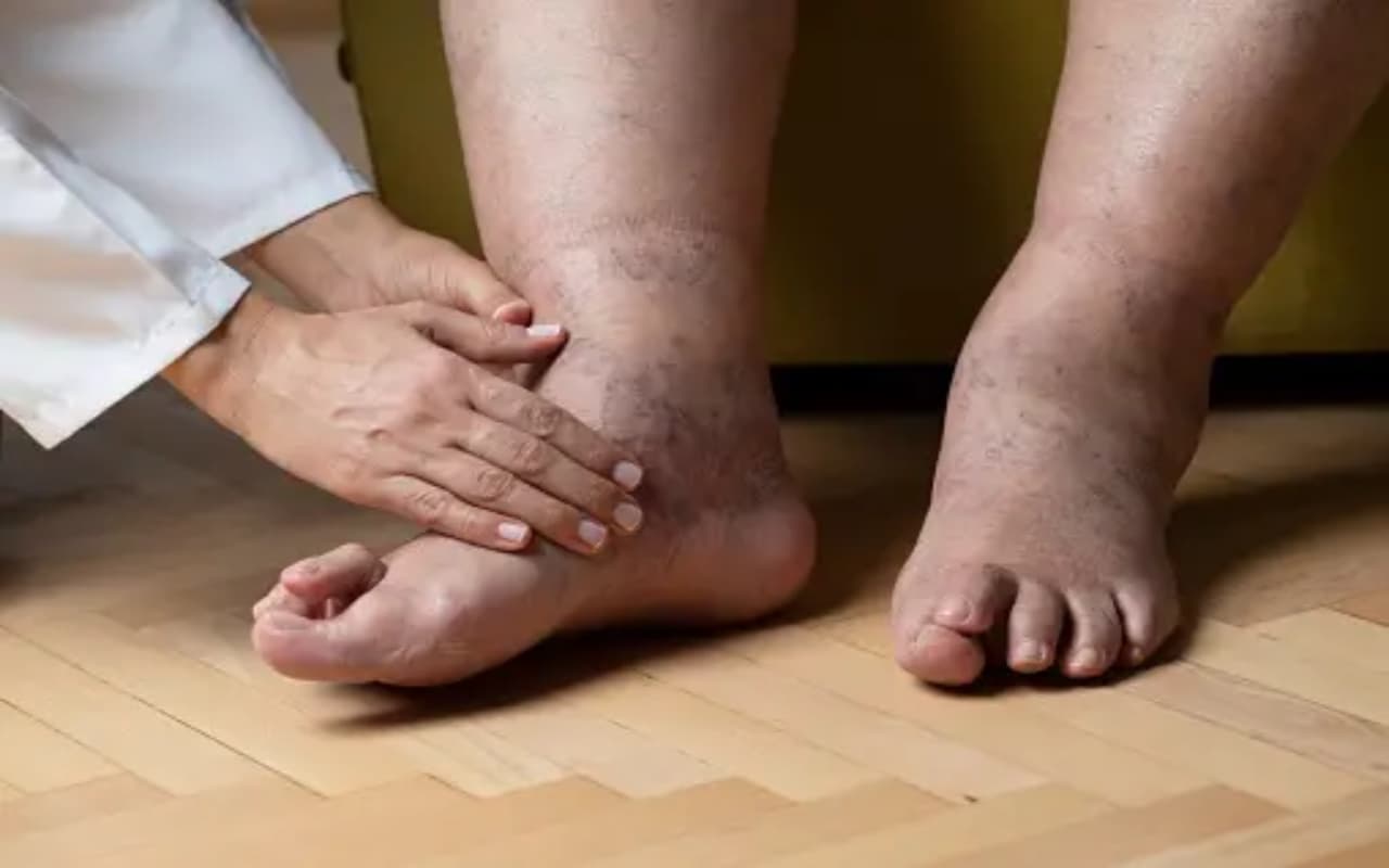 Swelling Feet Concern:  पैरों में हो रही सूजन को न करें नजरअंदाज, कई बीमारियों का हो सकता है कारण