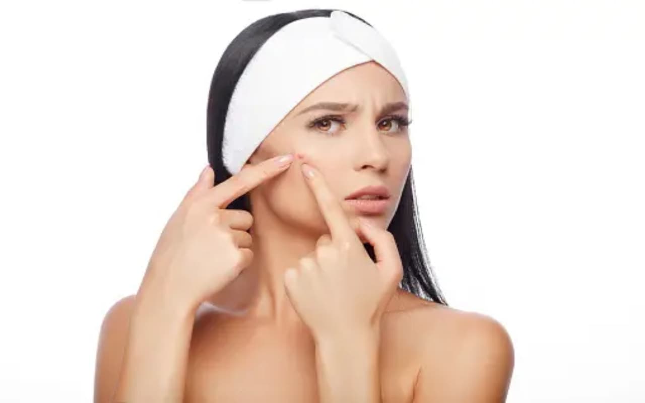 Skin Care Tips: आपकी खूबसूरती पर मुहांसो ने लगा दिया है दाग, आज ही कर लें ये उपाय, तुरंत मिलेगा छुटकारा
